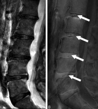 患有慢性腰背痛患者的磁力共振影像。圖左為傳統的T2W磁力共振影像，顯示患者有多節腰椎退化及椎體變異。圖右為UTE磁力共振影像，白色箭咀為UTE 椎間盤病徵（UDS）。
